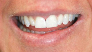 After bleaching/bonding